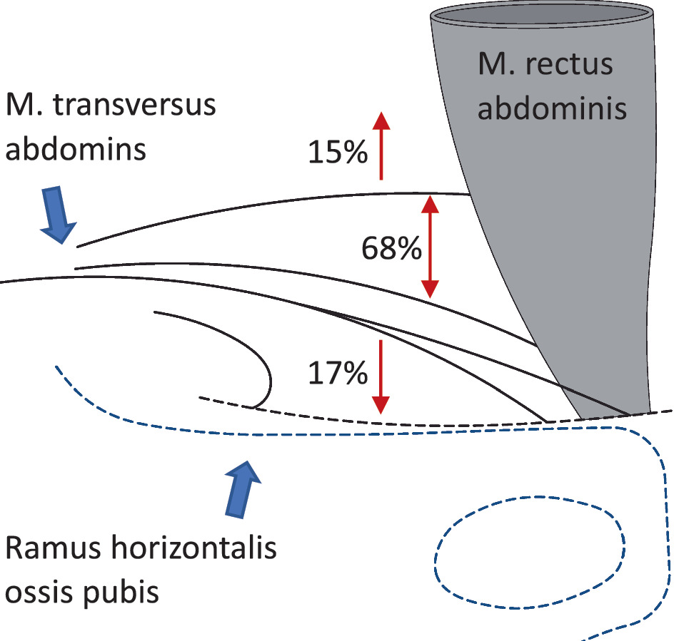 Leistenhernien Anatomie Klassifikation Und Klinik Springerlink