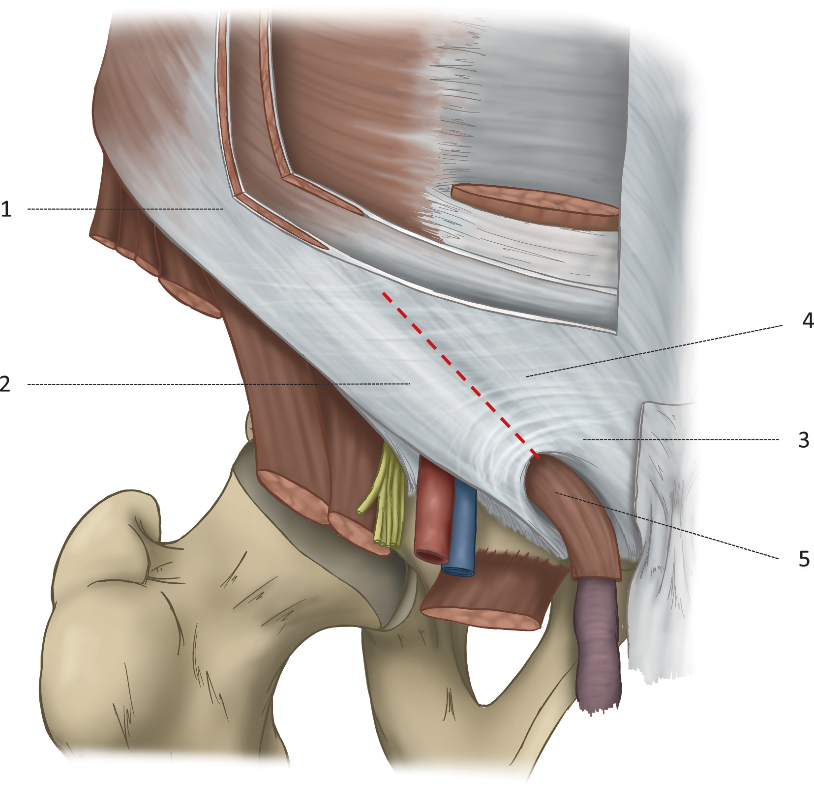 Leistenhernien Anatomie Klassifikation Und Klinik Springerlink