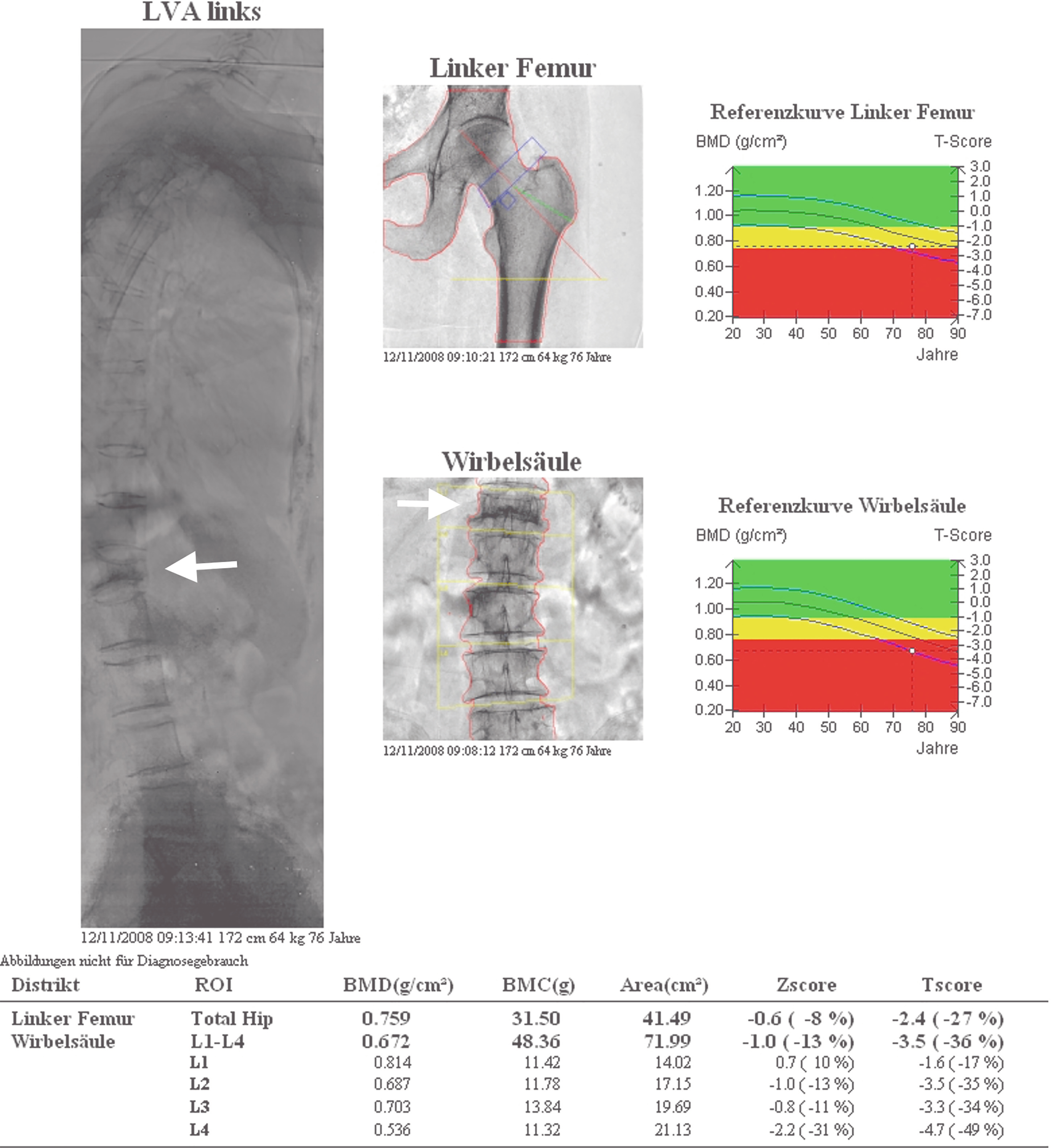 Osteoporosen [M80.- bis M81.9-] | SpringerLink
