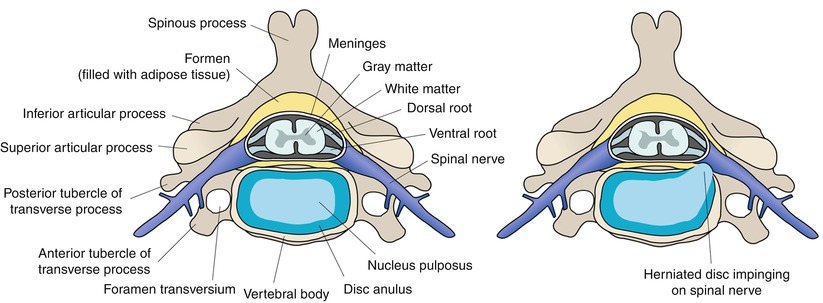 Intervertebral Disc Herniation: Pathophysiology and Emerging Therapies ...