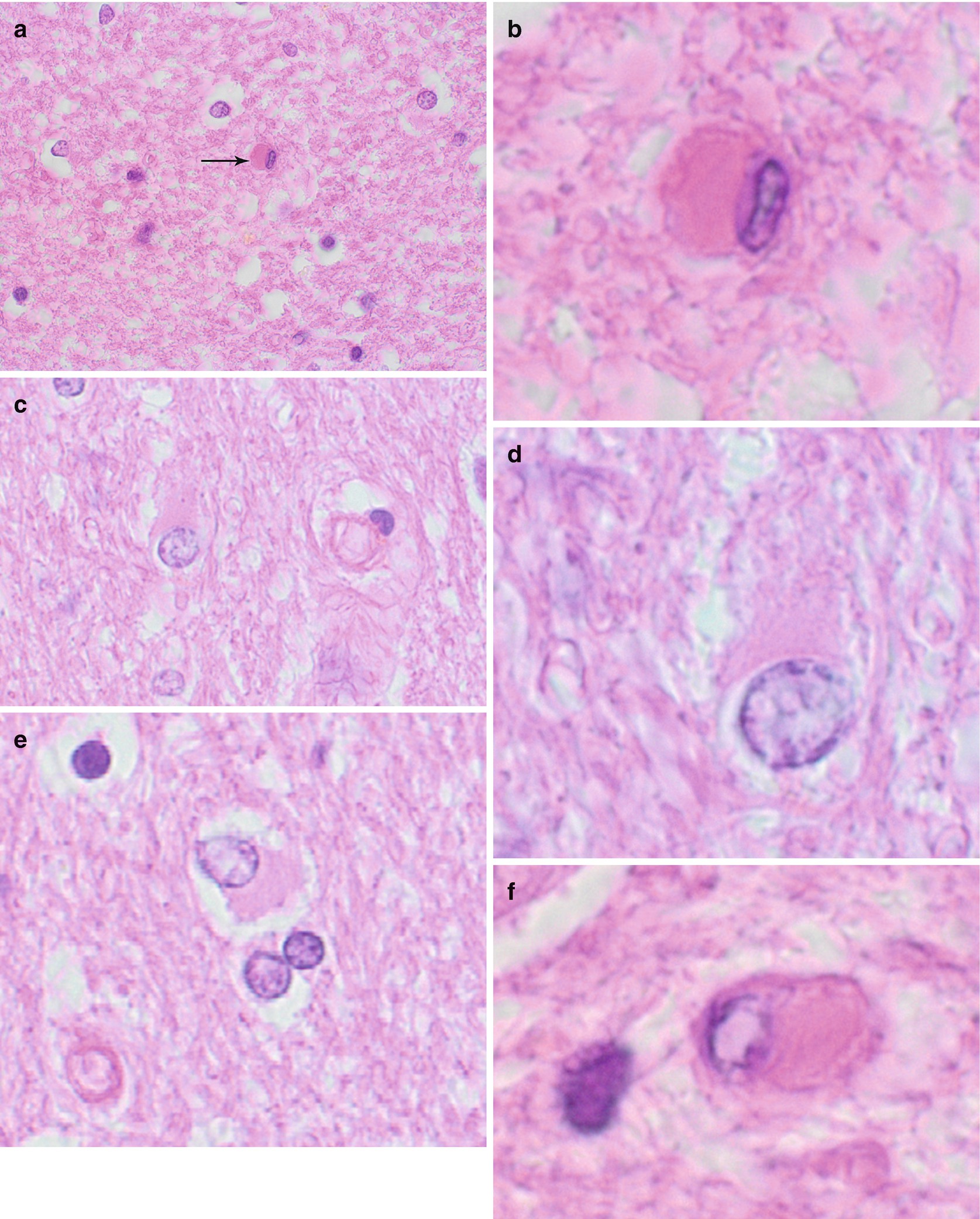 Neurodegenerative Diseases Multiple System Atrophy Msa Springerlink