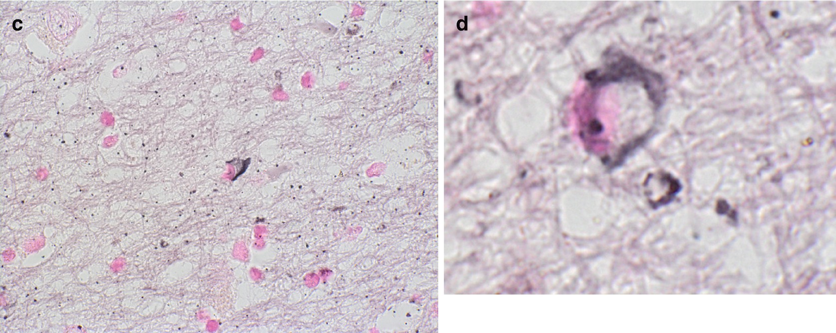 Neurodegenerative Diseases Multiple System Atrophy Msa Springerlink