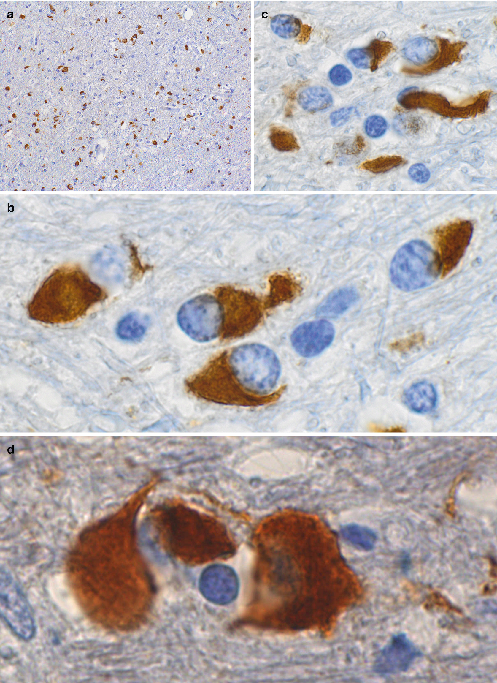 Neurodegenerative Diseases Multiple System Atrophy Msa Springerlink
