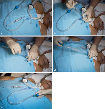 Absaugung Nach Tracheostomie Springerlink