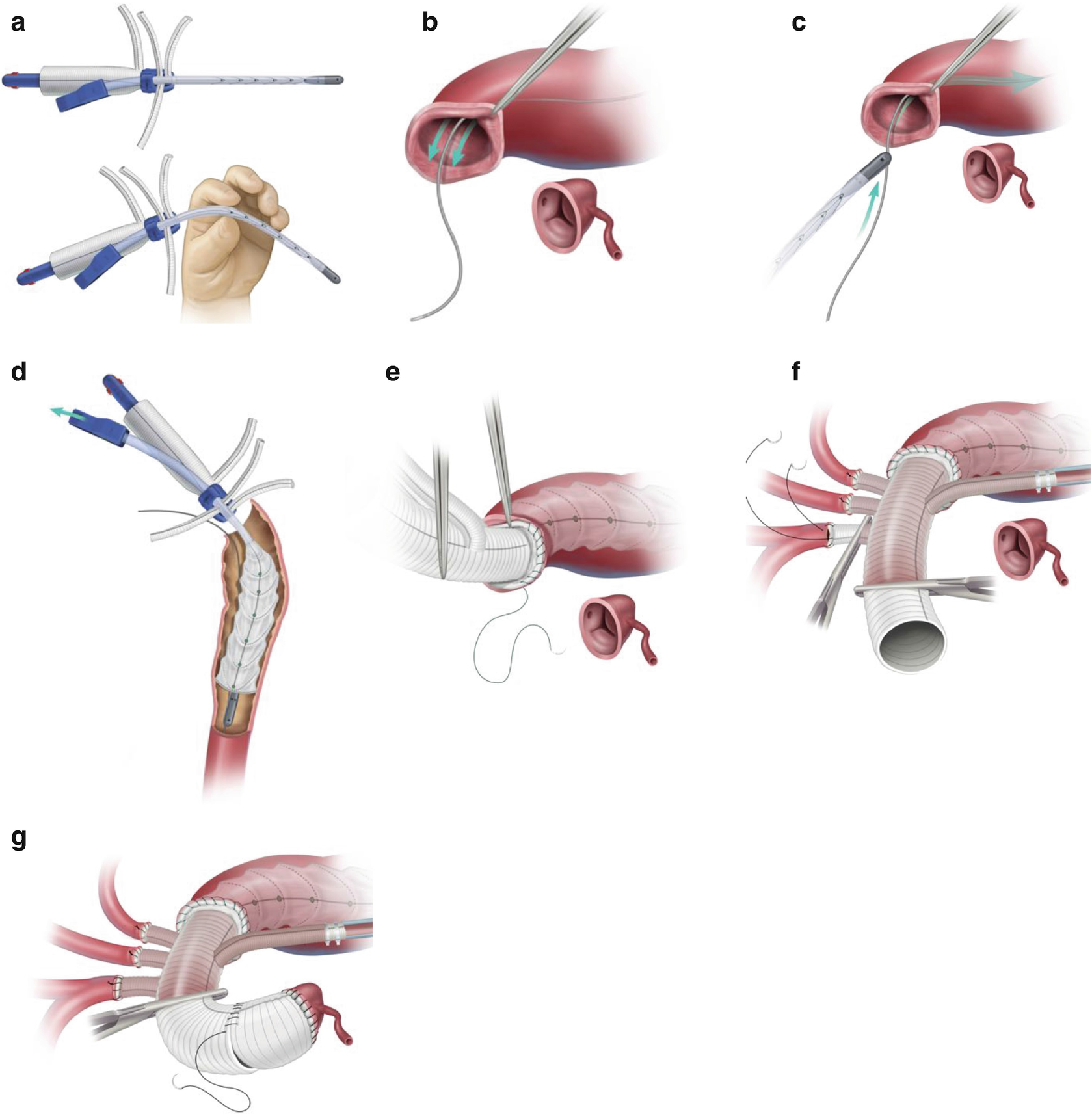 Elephant Trunk Technique(s) SpringerLink