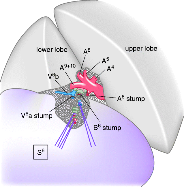 Segmentectomy of the Left Lower Lobe | SpringerLink