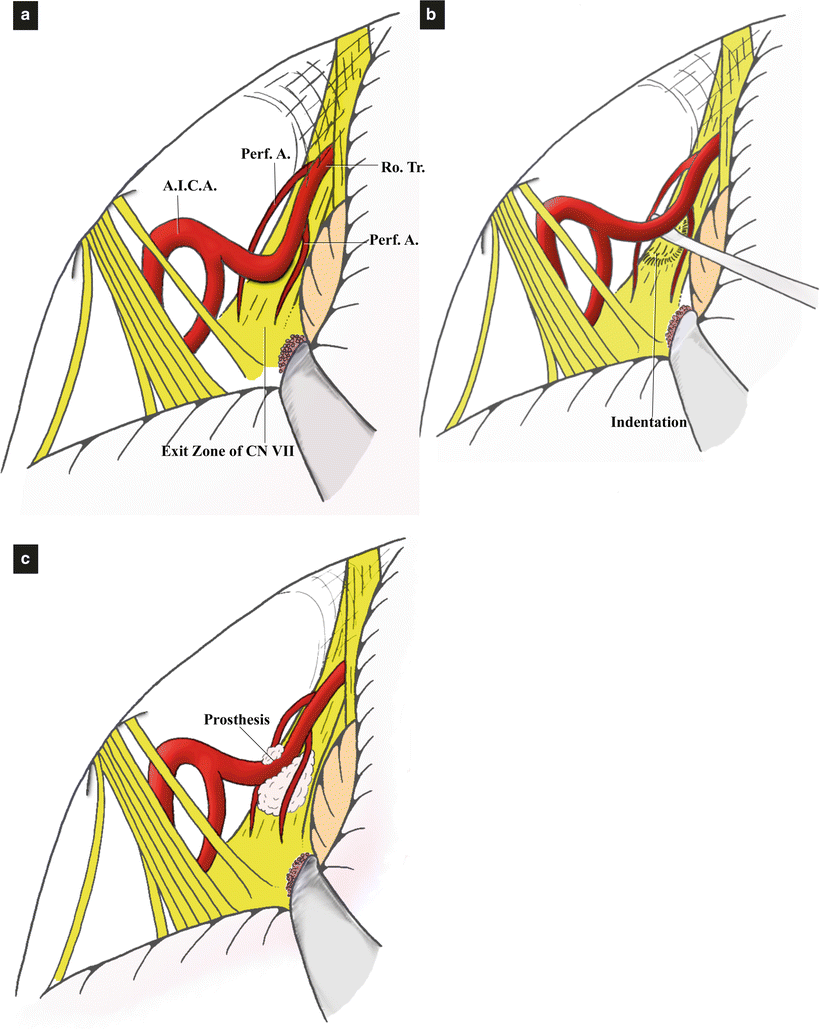 Microvascular Decompression Surgery For Hemifacial Spasm: The Lateral ...