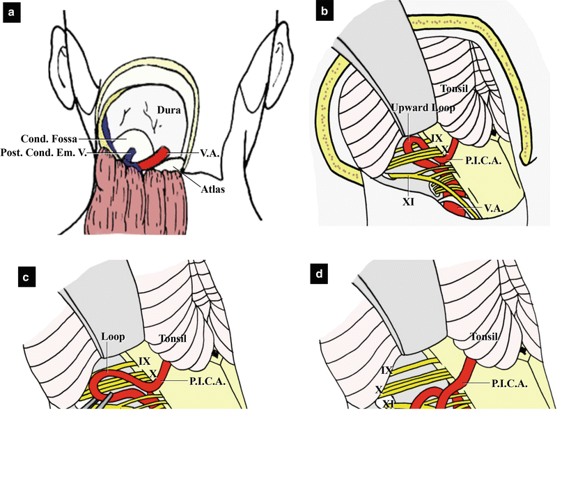 Microvascular Decompression For Glossopharyngeal Neuralgia Surgical