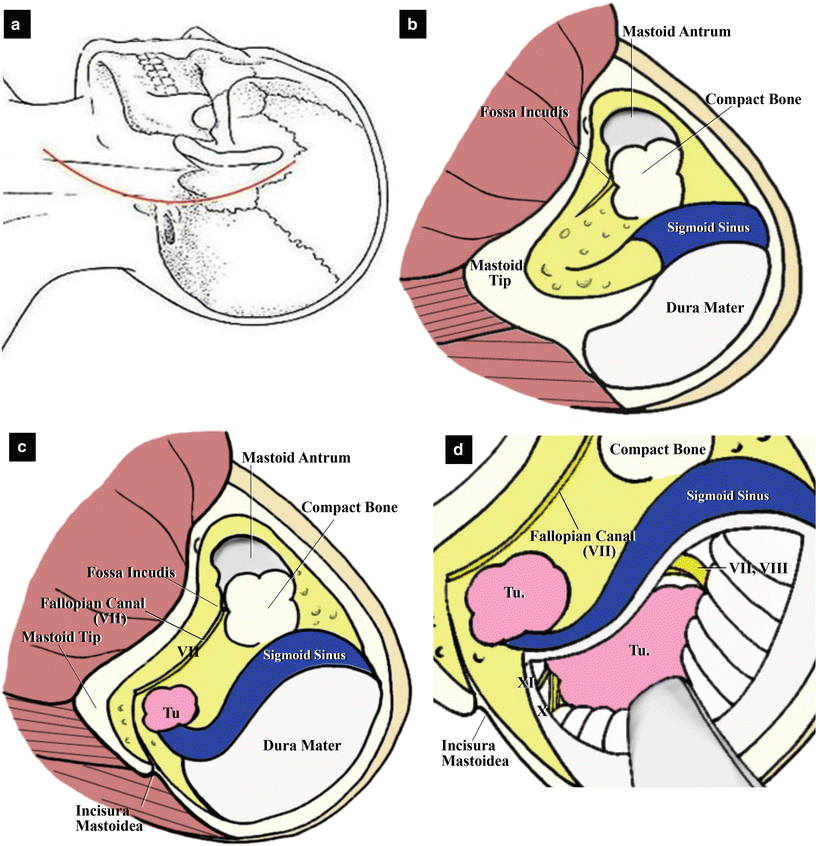 Microsurgical Anatomy of and Surgical Approaches to the Jugular Foramen ...