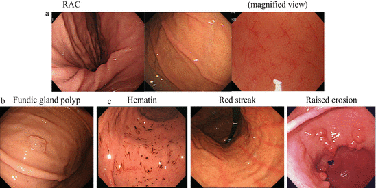 Endoscopic Findings Of H Pylori Infection Springerlink