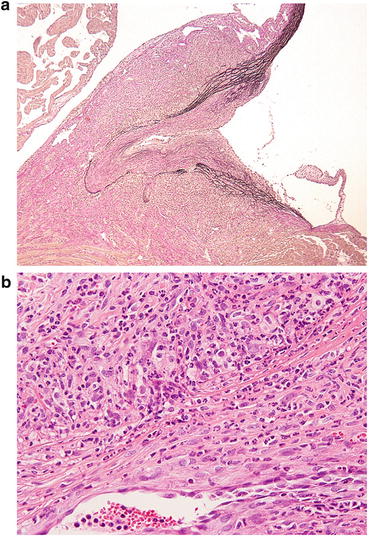 Histopathology of Coronary Arteritis in Acute Kawasaki Disease Murine Systemic Vasculitis Induced Albicans Cell Wall Polysaccharide | SpringerLink