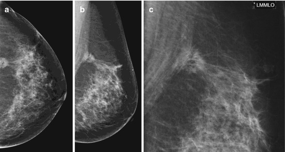 Analysis Of Mass Lesions And Architectural Distortion Springerlink