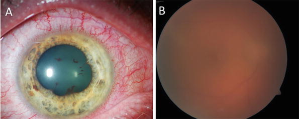 Syphilitic Uveitis | SpringerLink