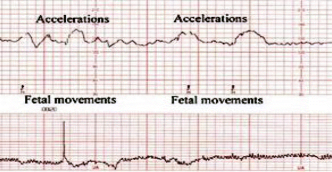 Obstetric Monitoring In Critically Ill Pregnant Women Springerlink