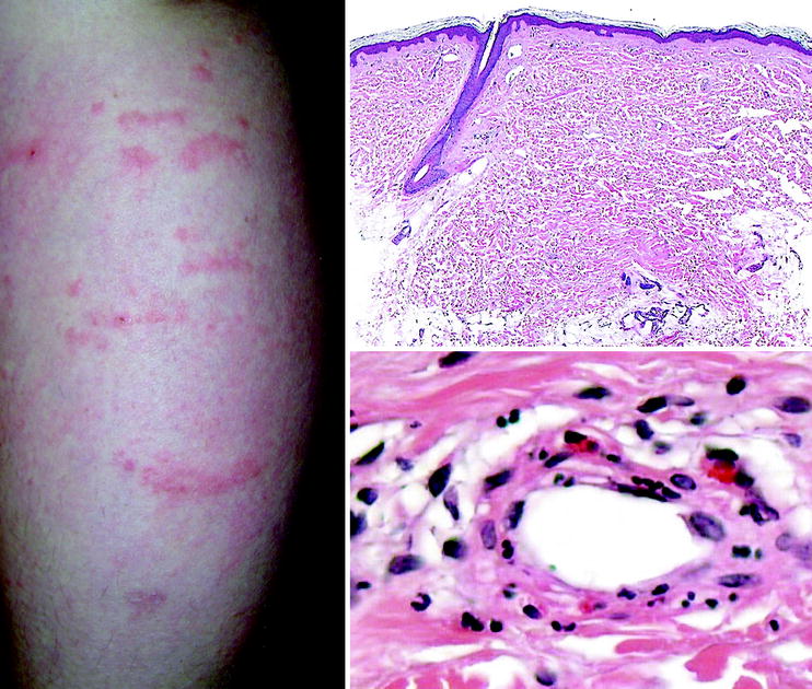 Cutaneous Cryoglobulinemic Vasculitis | SpringerLink