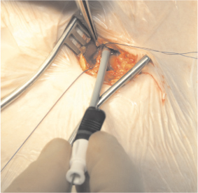 Modified Seldinger Technique For Open Central Venous Cannulation