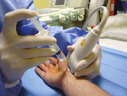 Trapeziometacarpal Joint Injection | SpringerLink