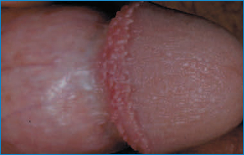 Pink pearly papules