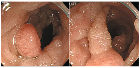 A Pedunculated Adenoma In The Terminal Ileum Springerlink