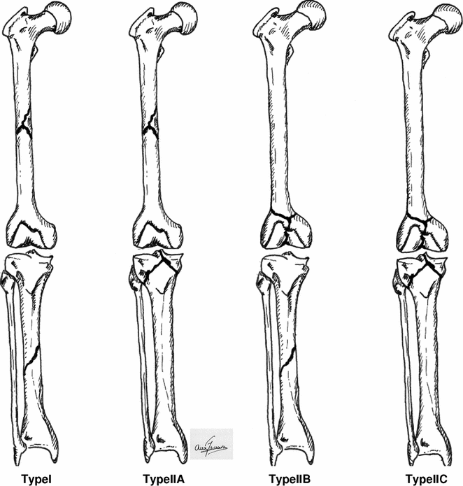 Floating Knee SpringerLink
