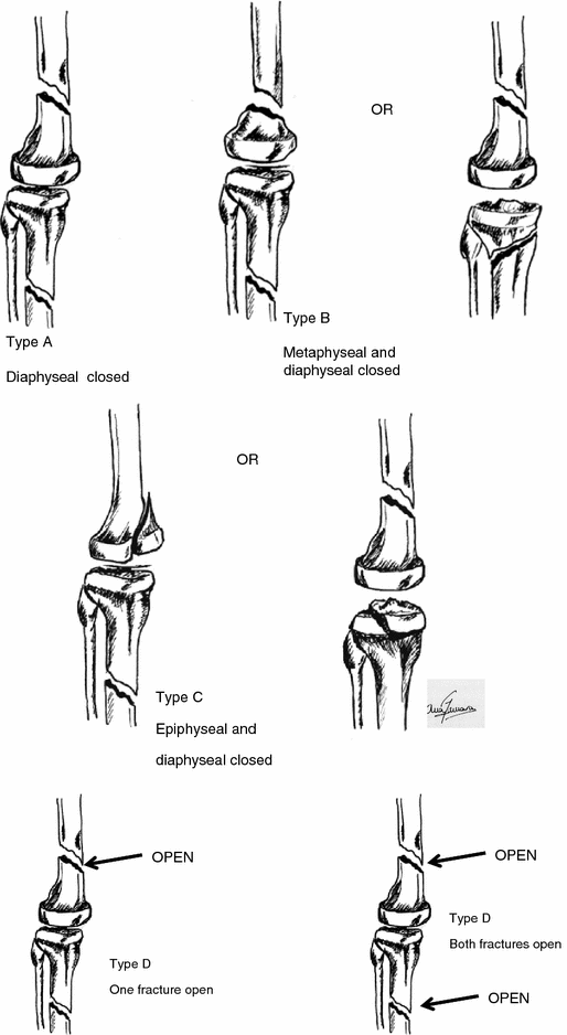 Floating Knee SpringerLink