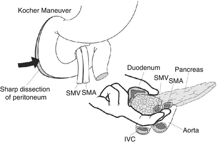 Surgical Treatment Of Duodenal Trauma Springerlink
