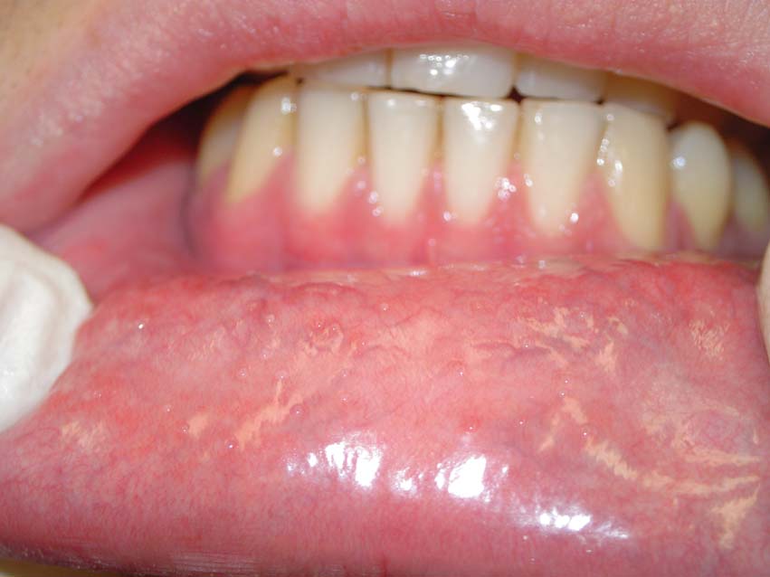 Forkølelsessår på tungen