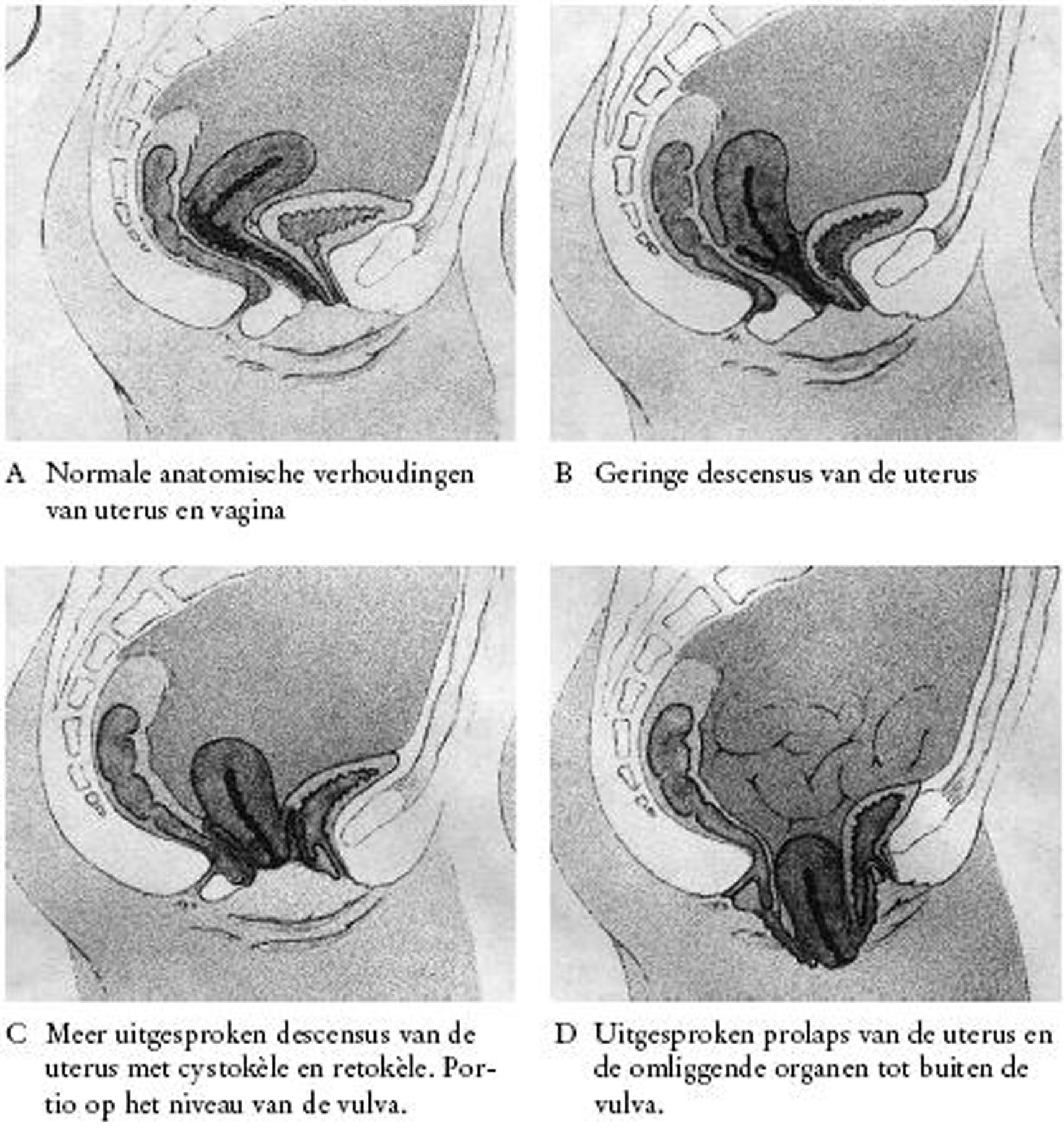 Baarmoederhals hoog stevig en open