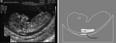 Wat Is Het Nut Van Foetale Nekplooimeting Rond 10 14 Weken Zwangerschap Springerlink