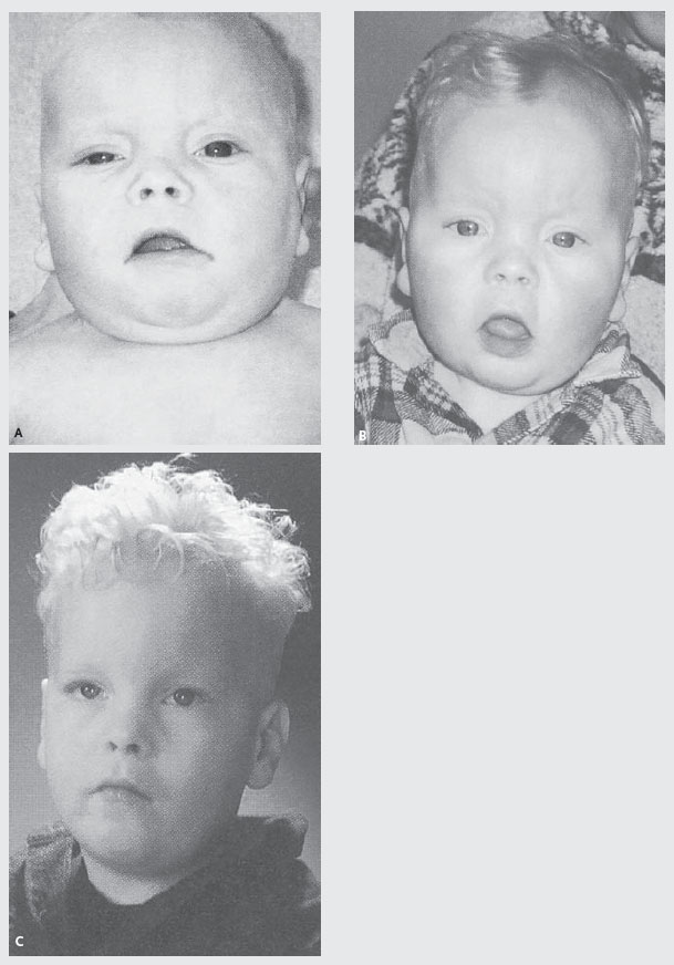 Genetische Syndromen Een Illustratie Springerlink