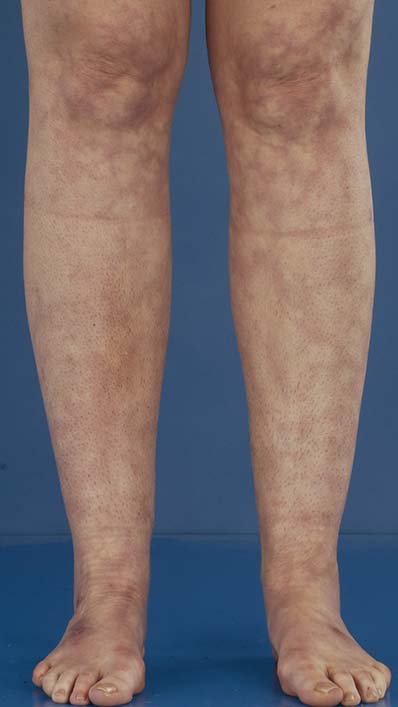 Rode gebroken bloedvaten op billen