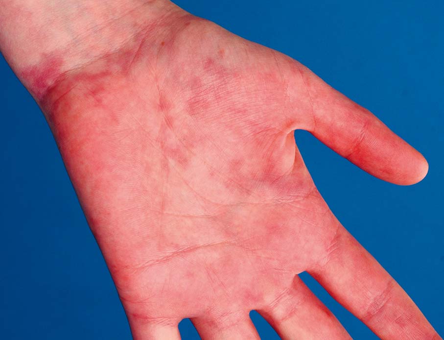 6 Erythemateuze Dermatosen Springerlink