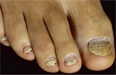 De gasten tuberculose B.C. Loslatende nagels | SpringerLink