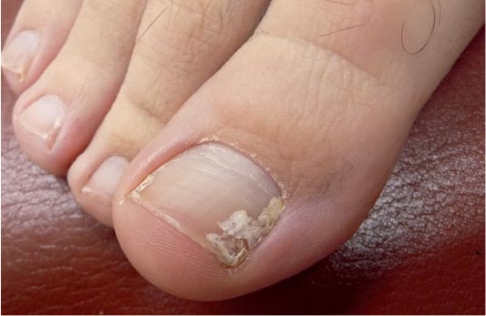 Verdorde voorzetsel Fervent Schimmelinfecties van de nagels | SpringerLink