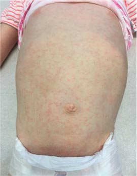 Vijfde Ziekte Erythema Infectiosum Springerlink