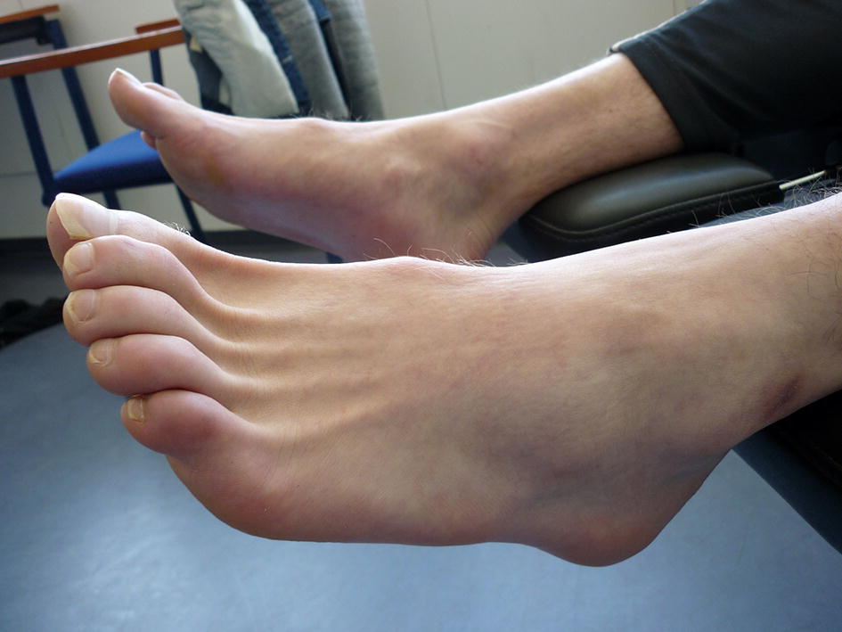 artralgie voeten