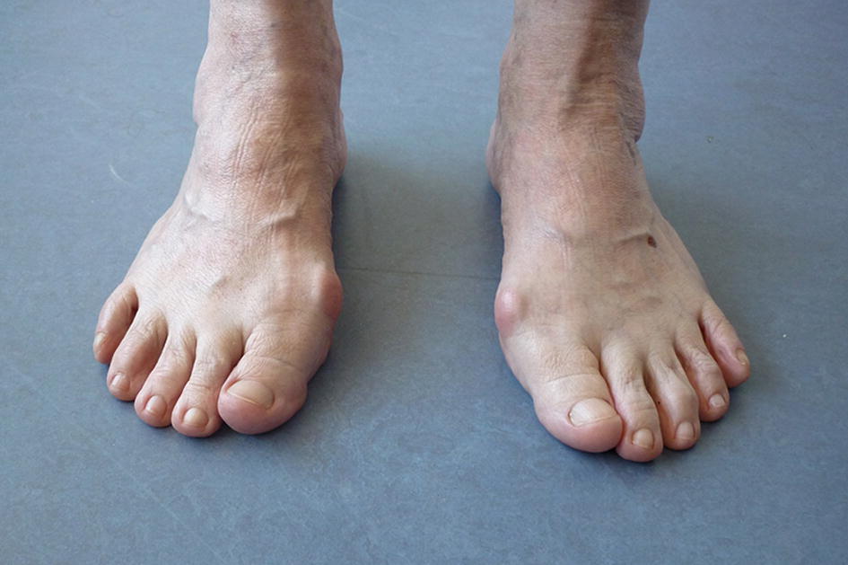 artralgie voeten