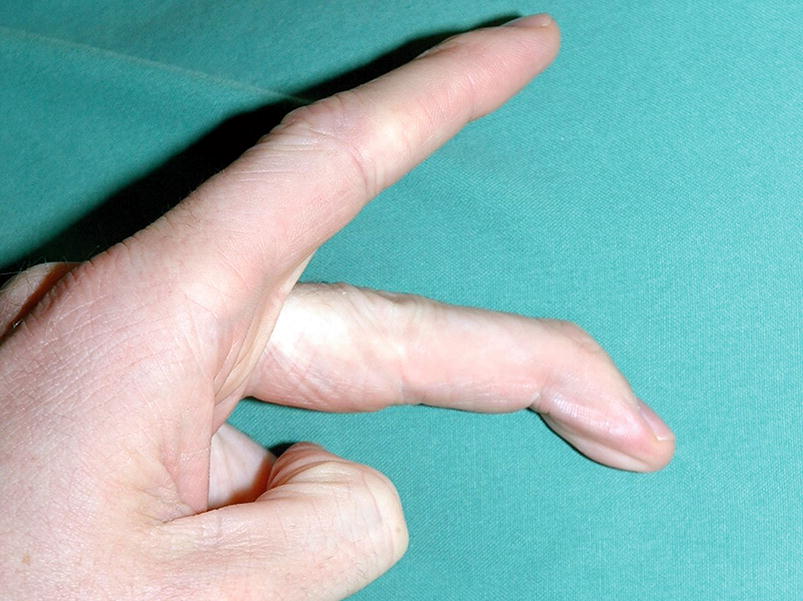 Mallet Finger Springerlink