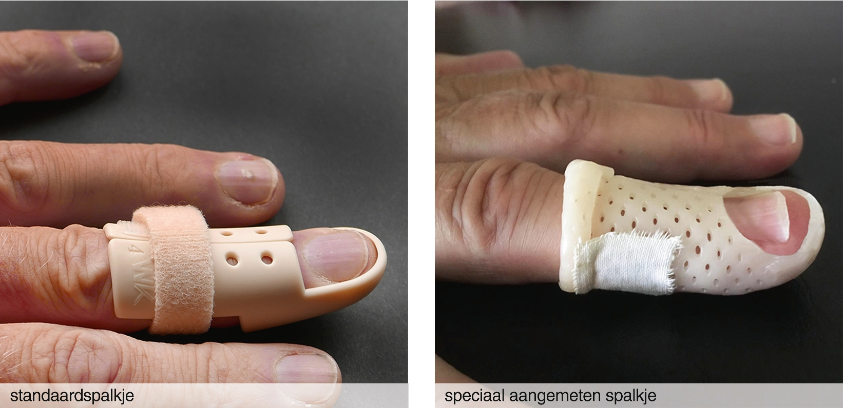 Mallet Finger Springerlink
