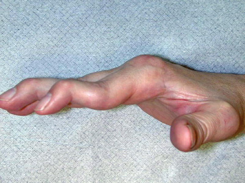 Mallet Finger Springerlink