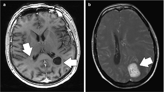 Breast Cancer Brain Metastases: Genetic Profiling and ...