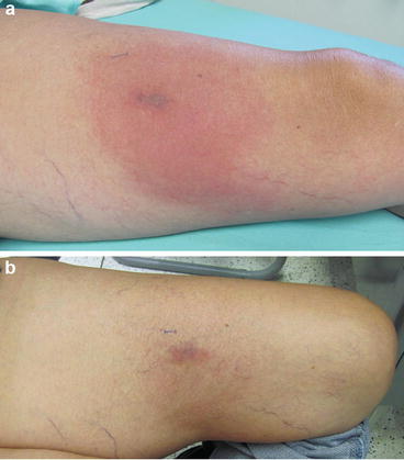 Loxosceles And Loxoscelism Biology Venom Envenomation And Treatment Springerlink