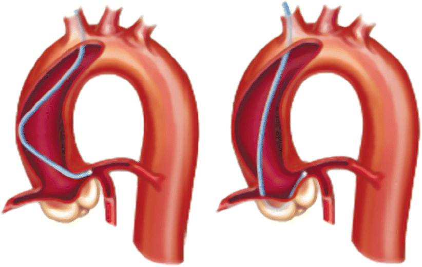 Selection and Manipulation of Guiding Catheter in Left Coronary