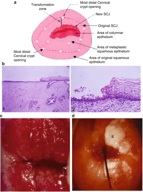 hpv impfung mann