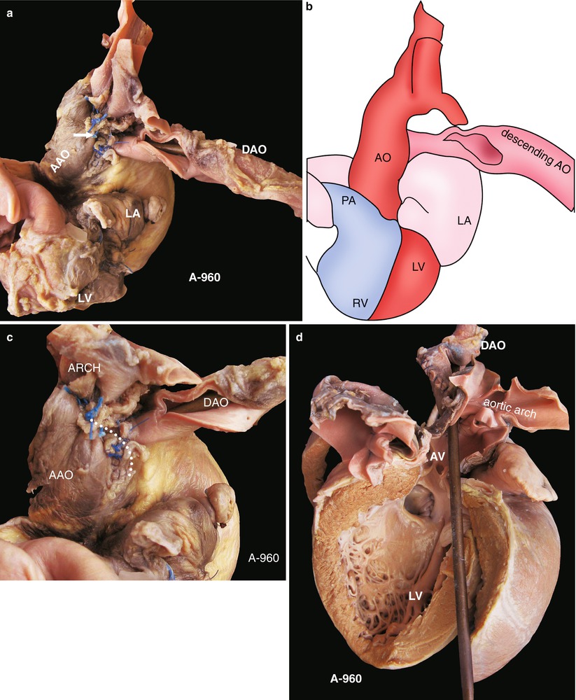 screening recommendations for interrupted aortic arch screening recommendations for interrupted aortic arch