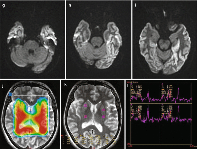 Å! 10+ Lister over Creutzfeldt-Jakob Disease: Prion diseases are very rare overall. Å! 10+ Lister over Creutzfeldt-Jakob Disease: Prion diseases are very rare overall.