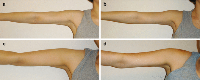 Body Contouring with Botulinum Toxin | SpringerLink