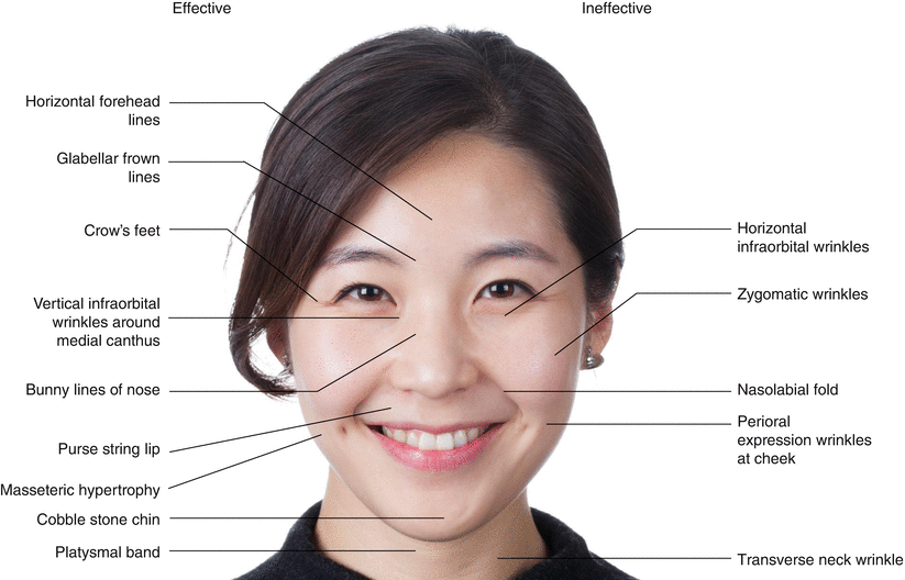 Clinical Anatomy For Botulinum Toxin Injection Springerlink