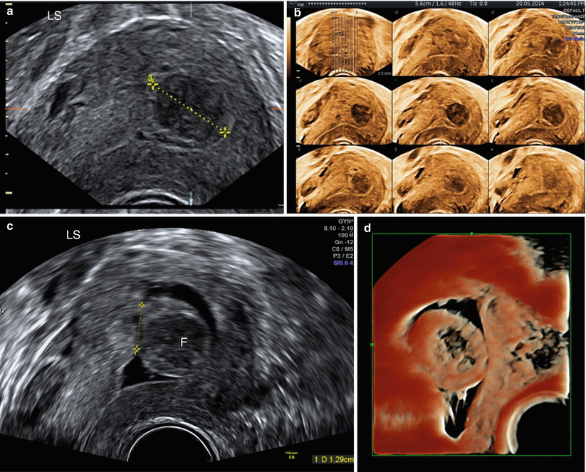 Ultrasound Evaluation of Myometrium | SpringerLink