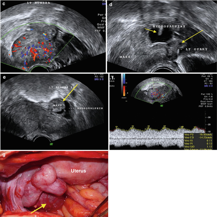 Ultrasound Evaluation Of Adnexal Pathology Springerlink